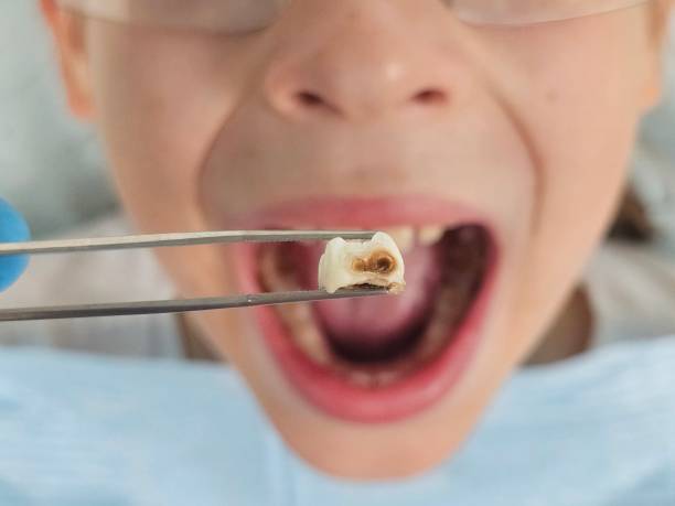 Best Emergency Tooth Extraction in Daniel, UT